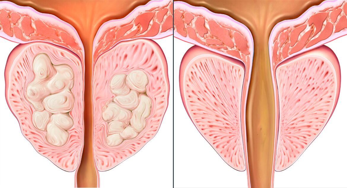 Prostatito gydymo Prostalix kurso etapai